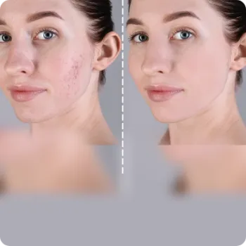 Acne and Blemish Removal