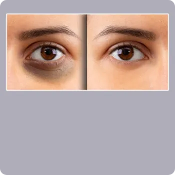 Complexion Adjustments