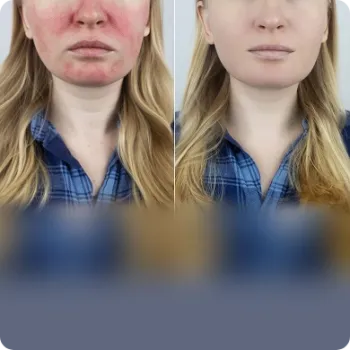 Redness Removal